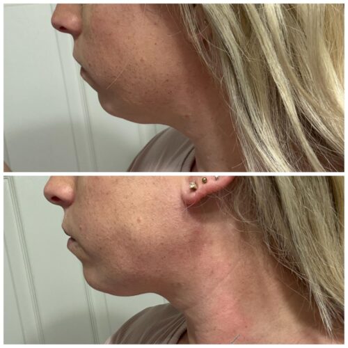 IBNUSA™  Neck Face Lifting Massager Skin Tighten Anti Wrinkle Double Chin photo review