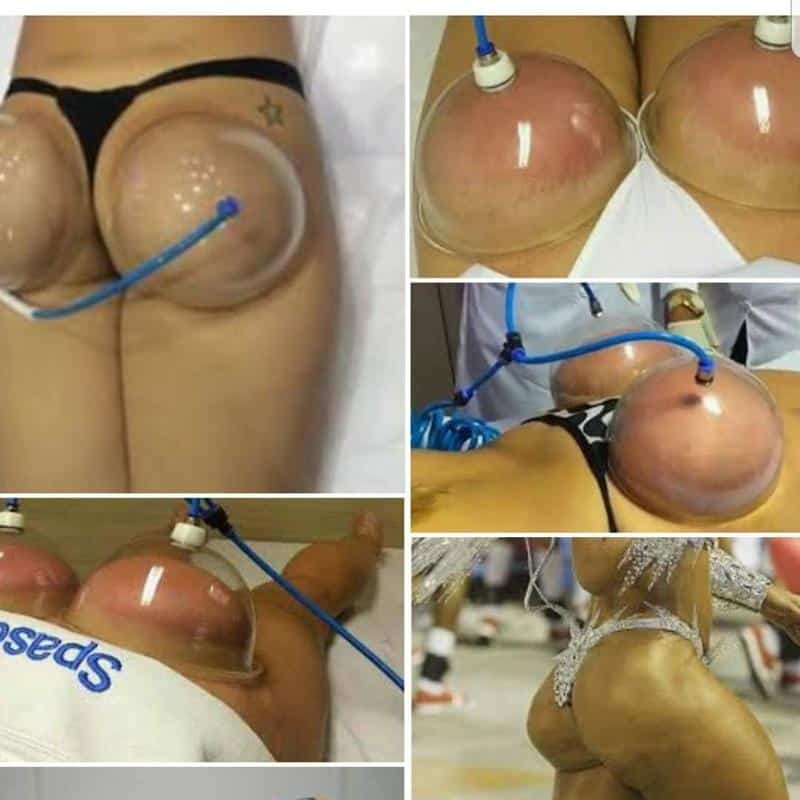 Handheld Vacuum Cupping Suction Device for Breast and Buttocks Lifting-iBeautyneed